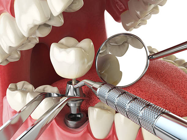 Best Knocked-Out Tooth (Avulsed Tooth) Treatment in , LA